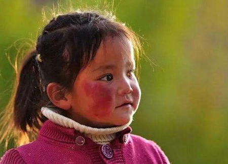 宝宝脸蛋红红的像高原红一样,是遗传吗?