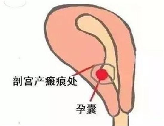 宫产瘢痕部位妊娠"具有创伤小,恢复快,费用相对低,可以保全子宫等优势