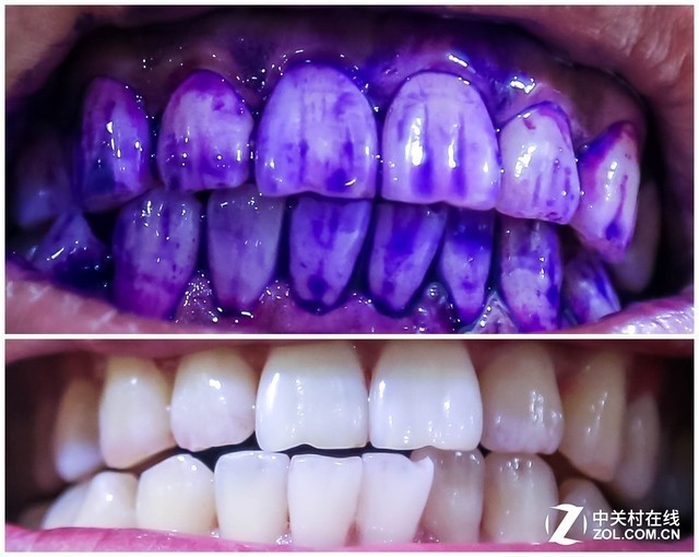 清洁前后牙齿对比