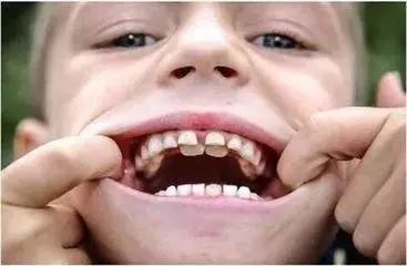 孩子换牙期一不小心会长出双排牙?