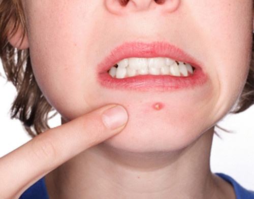 脸上有螨虫的四个症状.