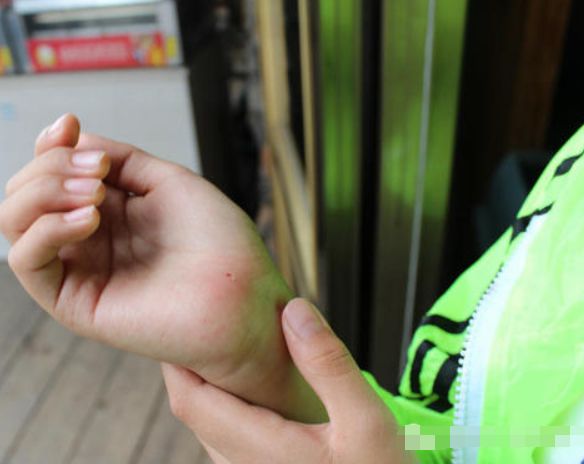 手上扎刺了,还在用针挑?在热水中泡点"它",刺儿自己跑出来