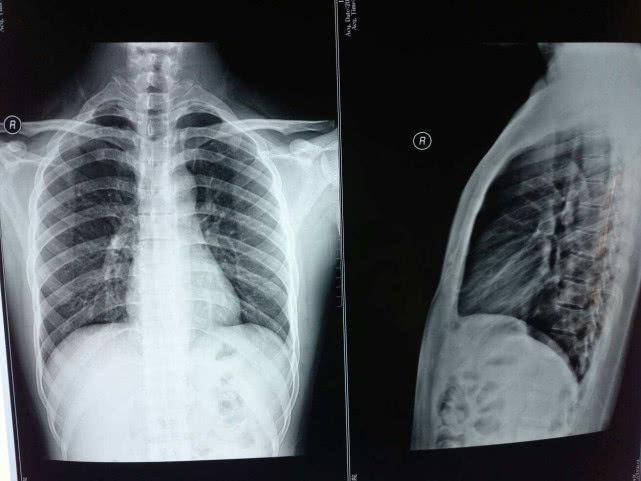 女生普遍都不愿做"胸透",究竟是为什么?女医生脸微红说出实话