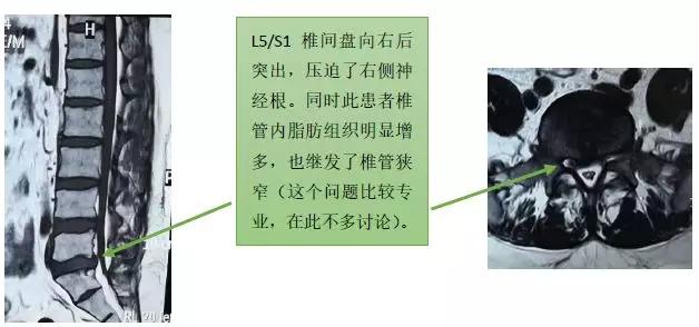 於是,我很認真地複習了他的所有影像資料,覺得就是單純的腰椎間盤突出