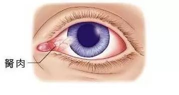 眼睛上长小息肉小心会致盲