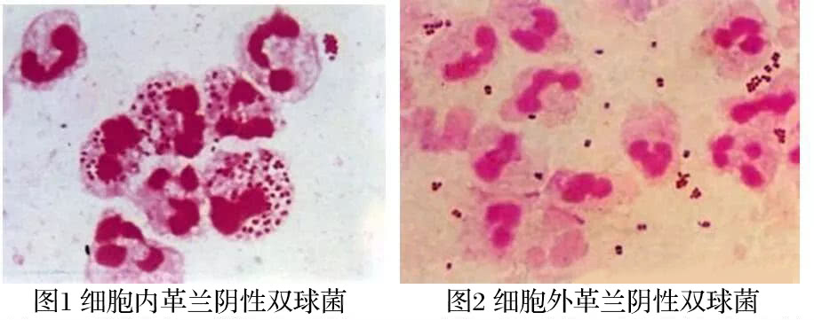 淋病双球菌图片图片