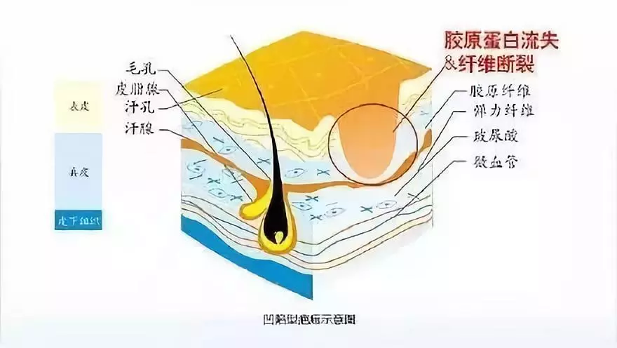 凹陷性疤痕的臨床表現