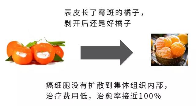 原位癌是指侷限於上皮層內的癌細胞,這種癌細胞還沒通過粘膜或皮膚的