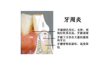 牙周袋发炎图片