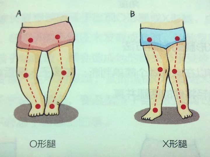 3歲後,又會呈現出膝關節向外翻,雙腿向內側彎曲的姿勢,稱為