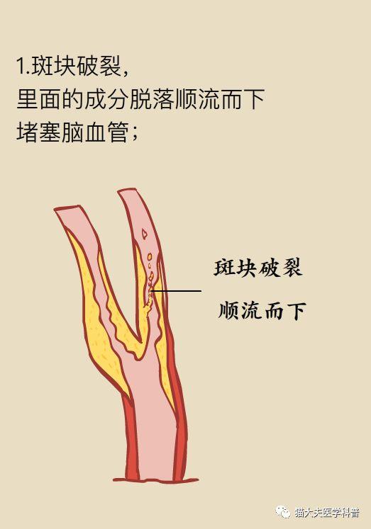 發現頸動脈斑塊是不是距腦中風不遠了