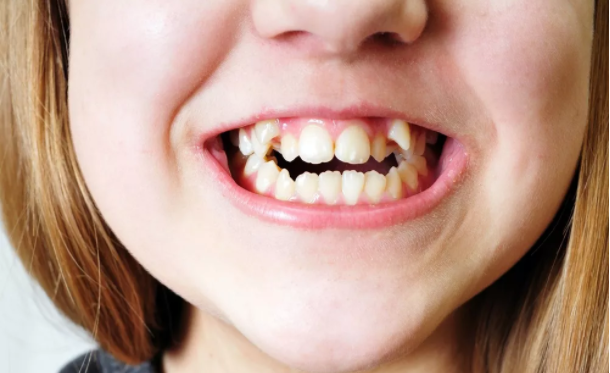 自己的牙齿不齐,会影响下一代的孩子吗?