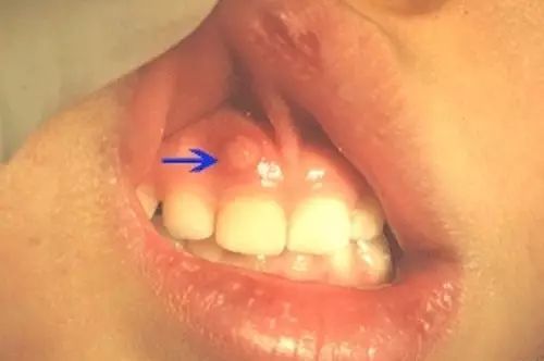 牙龈瘘管压迫图片