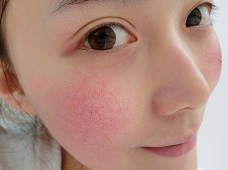 怎么样才算敏感肌 混合敏感肌肤用洗面奶推荐__凤凰网