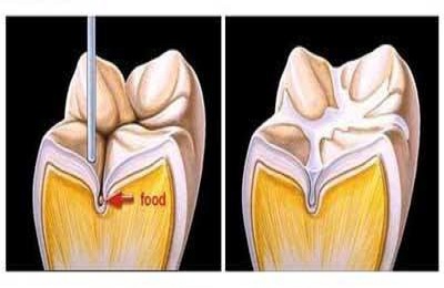 为什么要给孩子做窝沟封闭