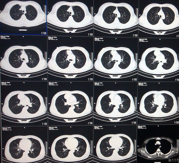 在实际的肺部ct检查中,每位检查者采集的是肺部的断面或立体图像,往往