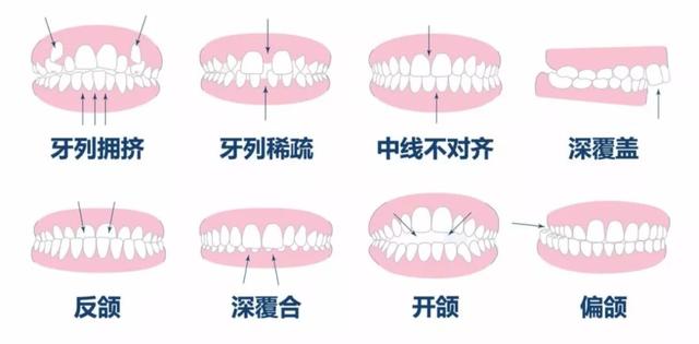 牙齒矯正黃金季,舊顏換新顏,笑容更自信!