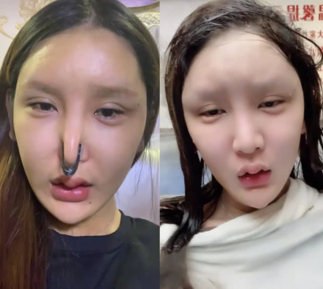 女子花86万整成"网红脸",整容前照片曝光,网友:简直辣眼睛__凤凰网