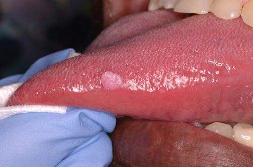 感染hpv舌头图片 症状图片