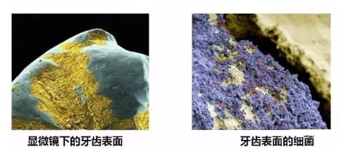 在酸的作用下,牙齿表面就会被腐蚀破坏.